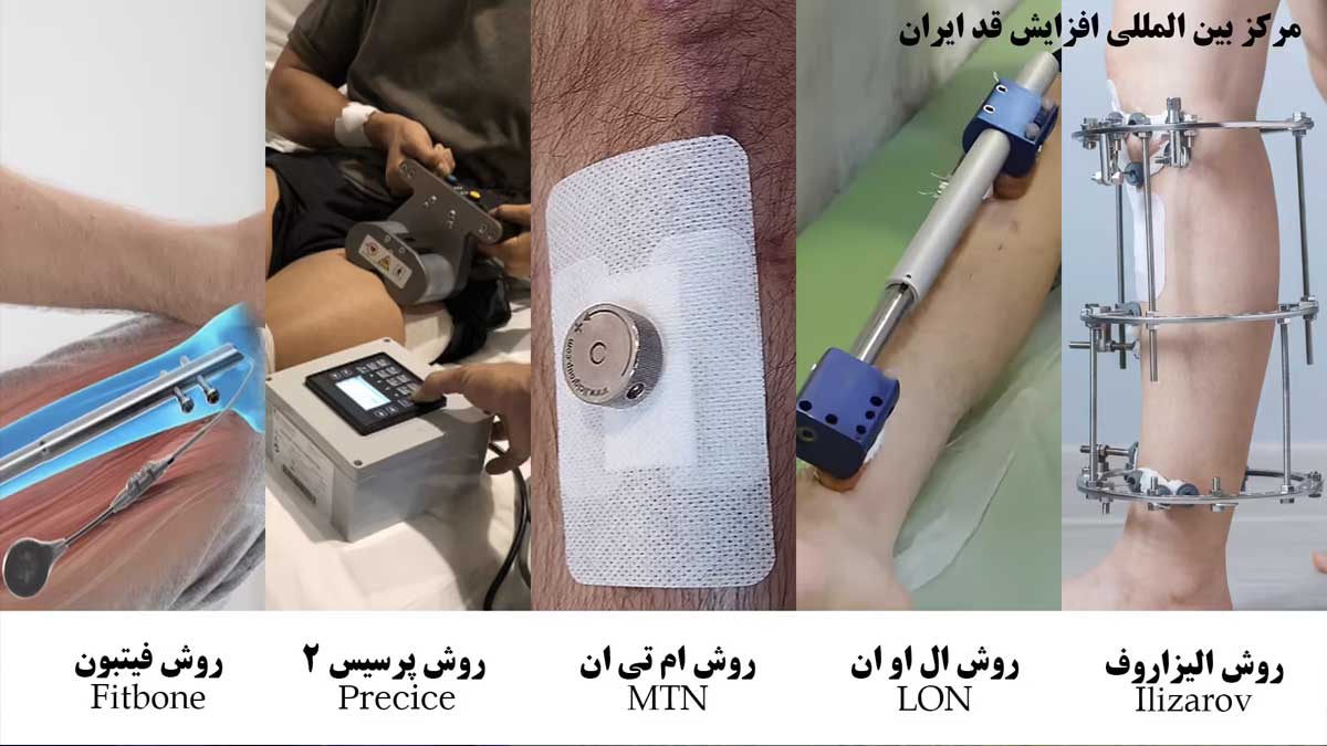 تفاوت بین روش‌های جراحی افزایش قد