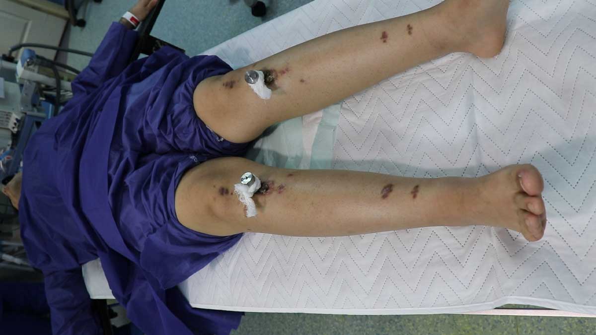ماندگاری و ثبات نتایج جراحی افزایش قد